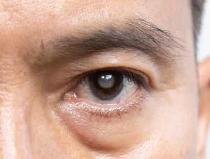 کاتاراکت (جراحی آب مروارید)