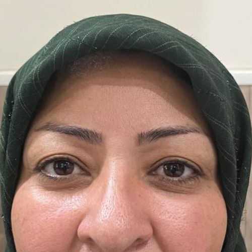 بلفاروپلاستی