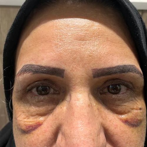 بلفاروپلاستی