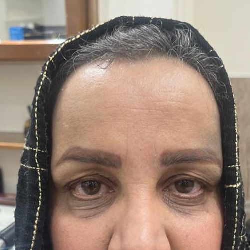 بلفاروپلاستی