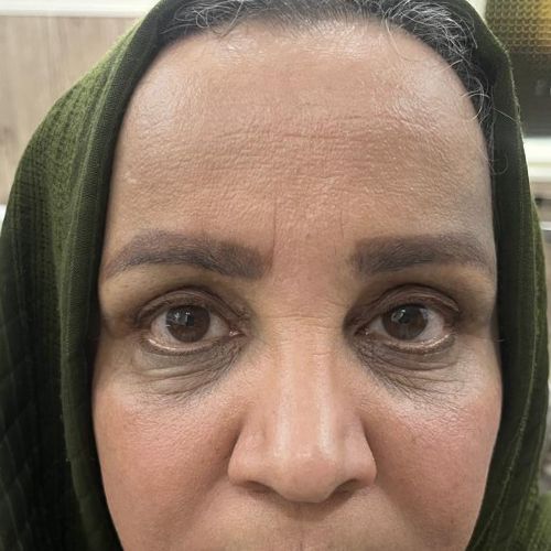 بلفاروپلاستی