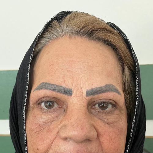 بلفاروپلاستی