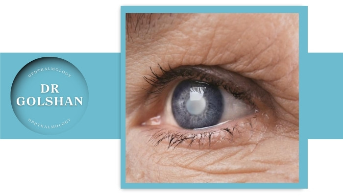 برگشت آب مروارید بعد از جراحی