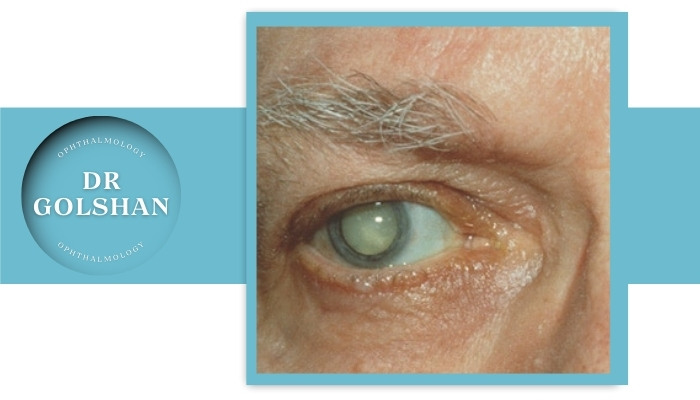 تشخیص کاتاراکت ثانویه