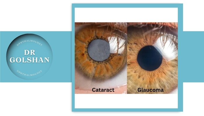 تفاوت آب مروارید با گلوکوم (آب سیاه)