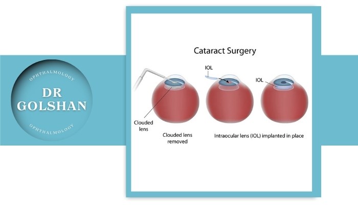 درمان آب مروارید در جوانی