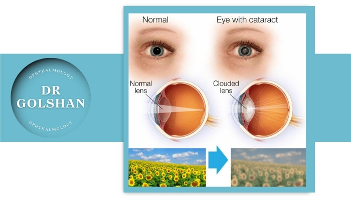 علائم کاتاراکت و آب سیاه