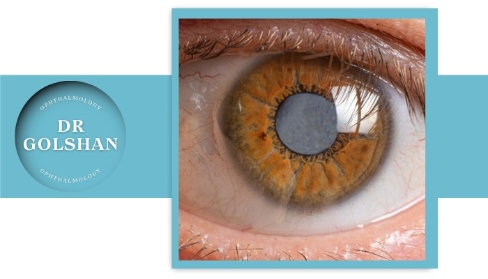 علائم کاتاراکت در سن کم