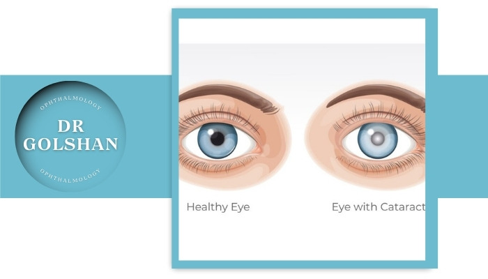 علائم بازگشت آب مروارید