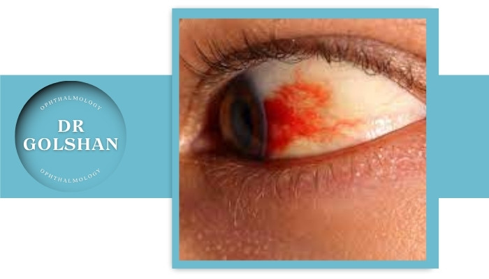 علائم بیماری‌های چشمی در افراد دیابتی