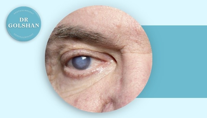 چه عواملی باعث برگشت آب مروارید بعد از جراحی می‌شوند؟