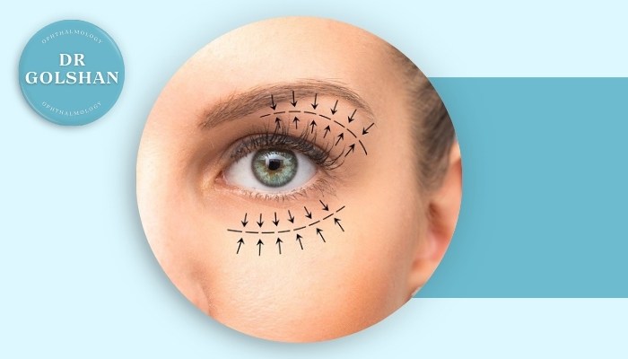 علت کوچک شدن چشم بعد از عمل بلفاروپلاستی چیست؟